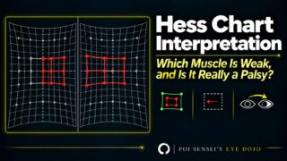 Hess chart interpretation: which muscle is weak, and is it really a palsy? Two Hess charts side by side with a smaller paretic field, a yoke muscle overacting, and an eye that will not abduct