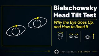 Bielschowsky head tilt test: the eyes counter-roll when the head tilts, and in superior oblique palsy the affected eye goes up