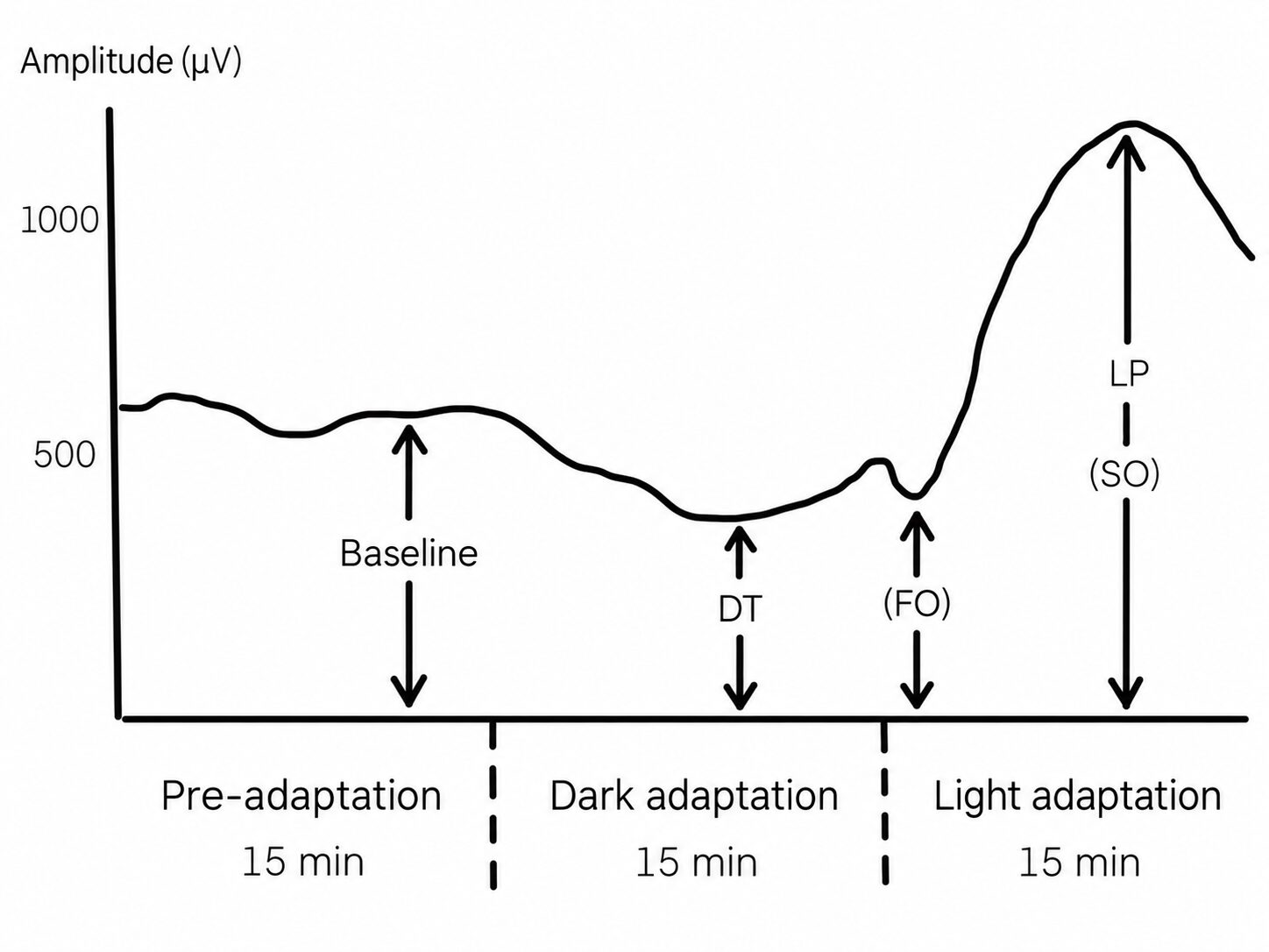 EOG curve: amplitude in microvolts against time through 15 minutes each of pre-adaptation, dark adaptation and light adaptation, with the baseline, the dark trough (DT) and the light peak (LP) marked