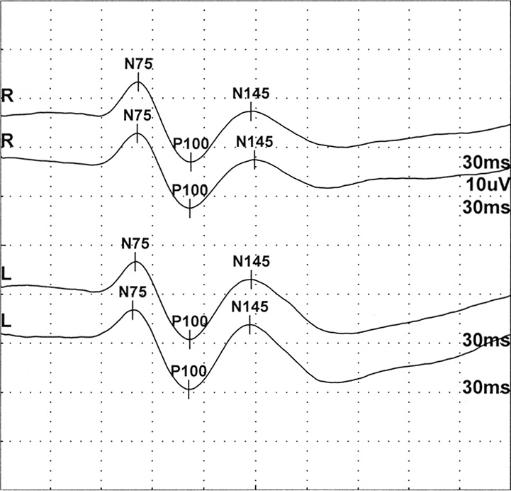 Normal pattern-reversal VEP traces of the right and left eye, each showing N75, P100 and N145, with 30 ms and 10 µV scale marks