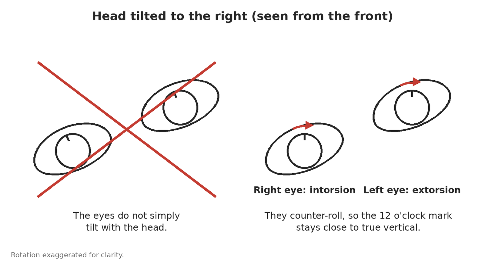 Diagram of the eyes when the head is tilted to the right: they do not tilt with the head but counter-roll, the right eye intorting and the left eye extorting