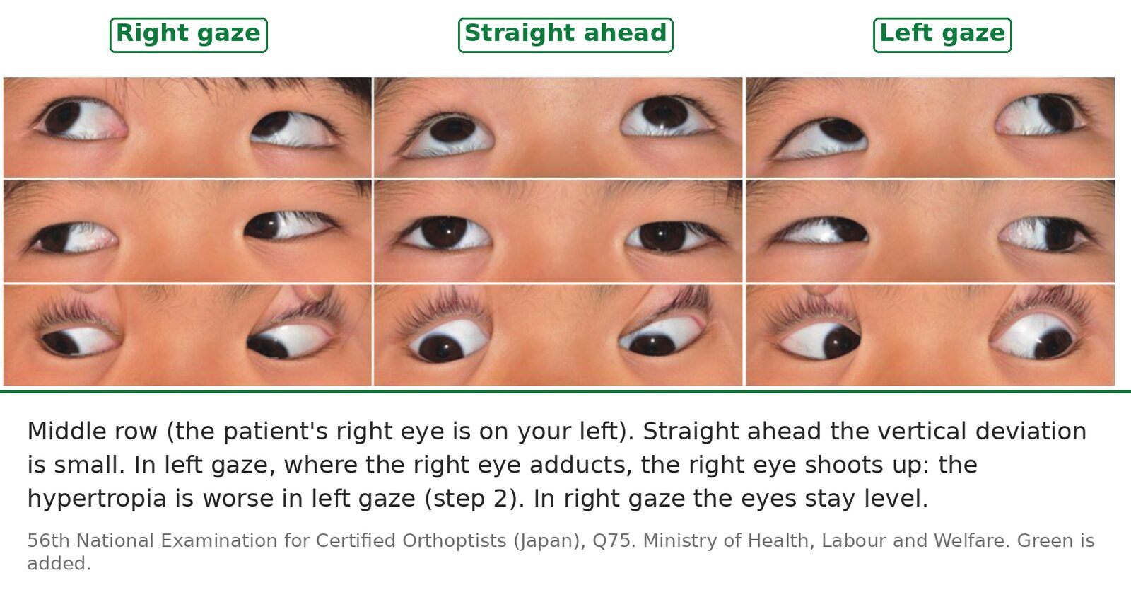 Nine-gaze photographs of the same child: in left gaze the adducting right eye shoots up