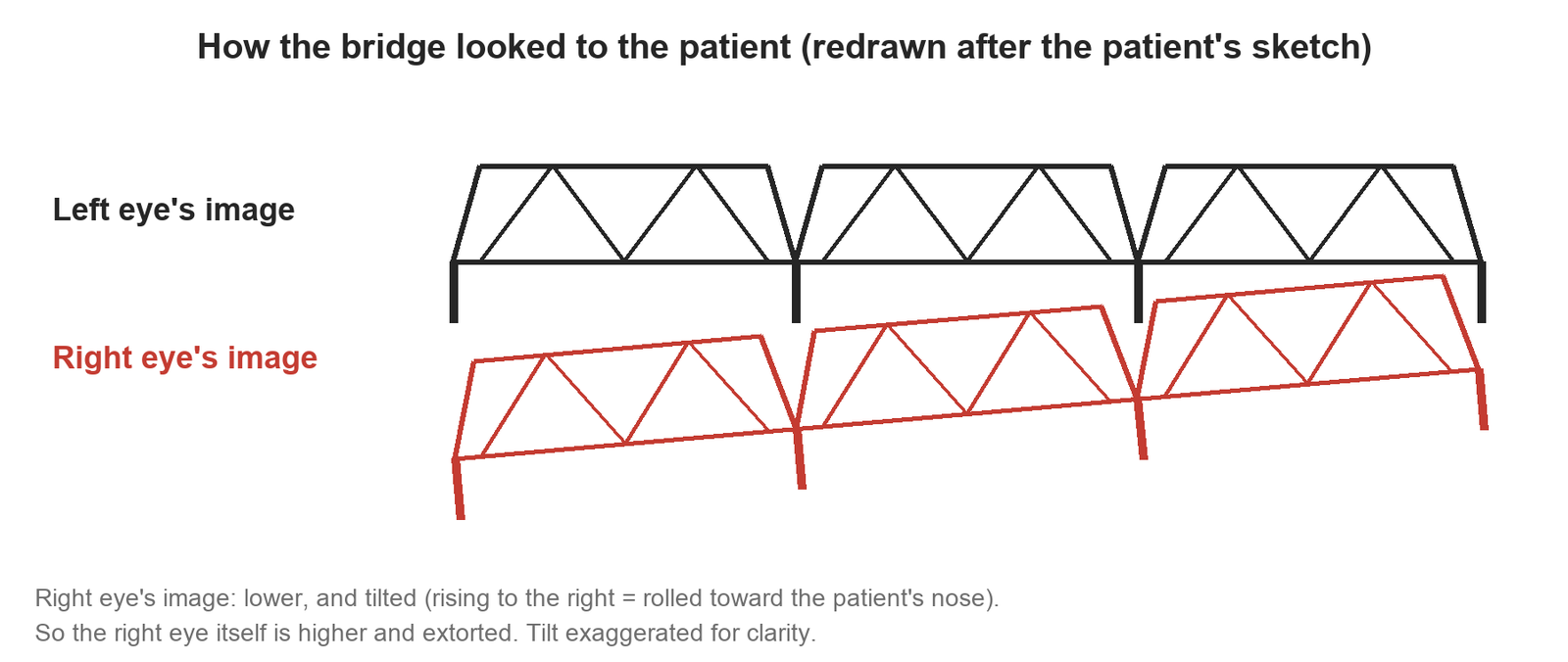 Two drawings of the same truss bridge: the left eye's image is level, and the right eye's image sits lower and tilts up to the right