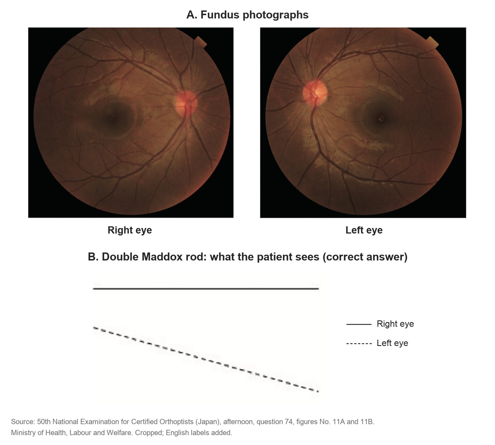 Fundus photographs of both eyes, with the left fovea well below the disc, and the double Maddox rod result: a level solid line for the right eye and a lower dashed line sloping down to the right for the left eye