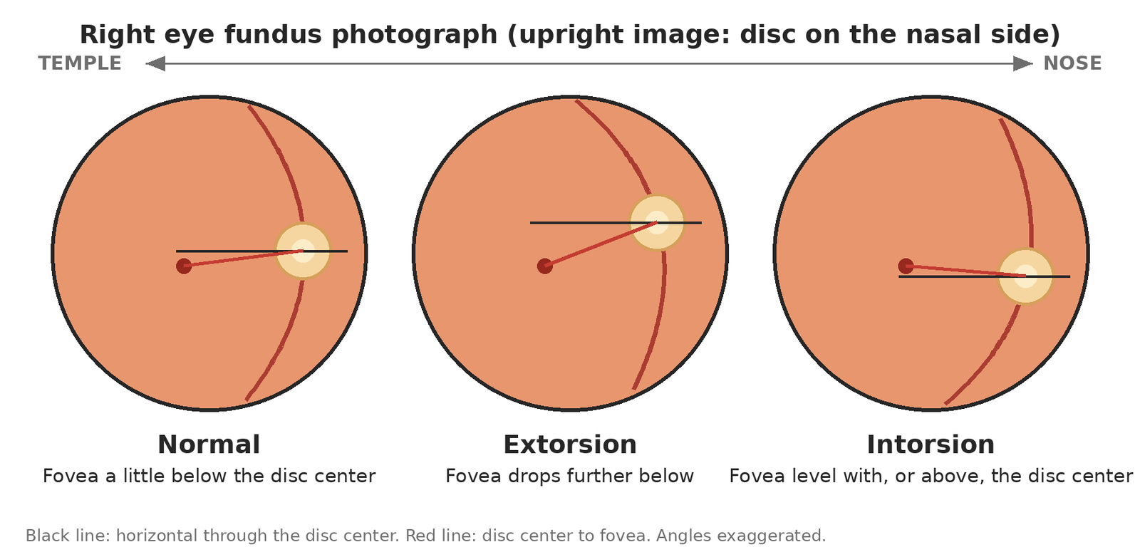 Schematic right-eye fundus photographs: normal with the fovea a little below the disc center, extorsion with the fovea further below, intorsion with the fovea level with or above the disc center