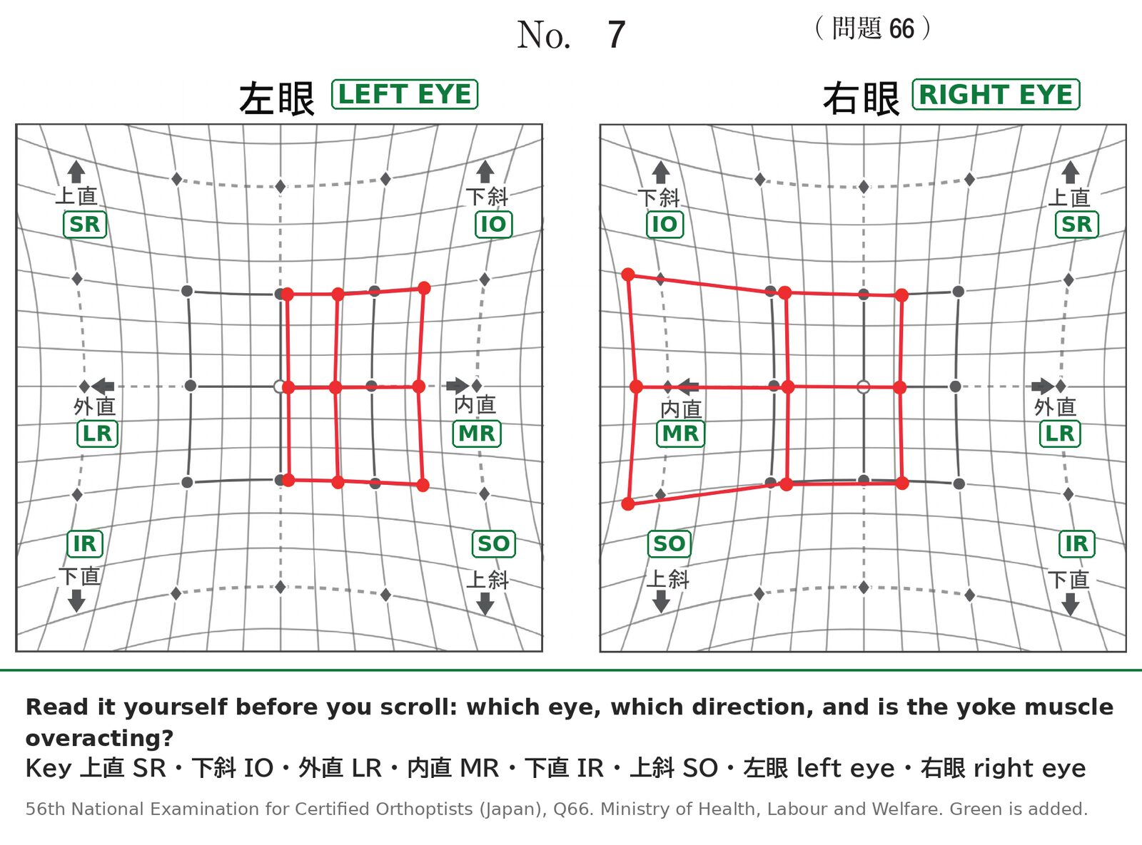 Hess chart of a 65-year-old man with two days of diplopia, with English muscle labels added