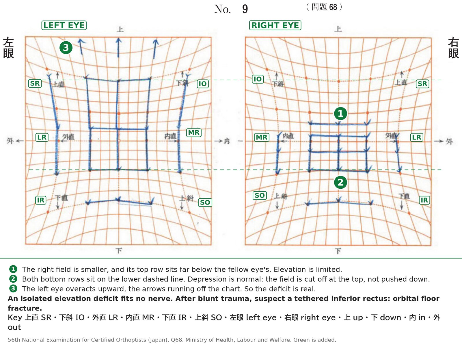 Hess chart of a 29-year-old man after blunt facial trauma, showing limited right elevation