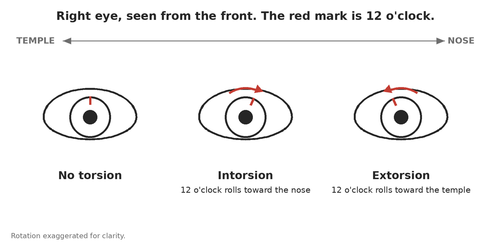 Right eye seen from the front: no torsion, intorsion with the 12 o'clock mark rolling toward the nose, and extorsion with the mark rolling toward the temple