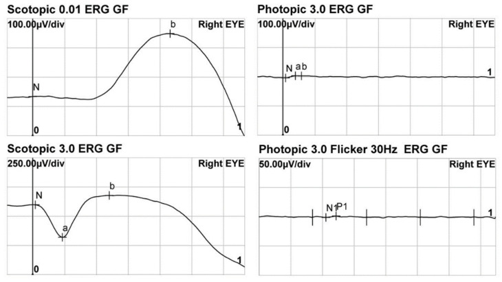 Full-field ERG of a child with achromatopsia. The dark-adapted rod and mixed responses are recorded, but the light-adapted cone response and 30 Hz flicker are flat.