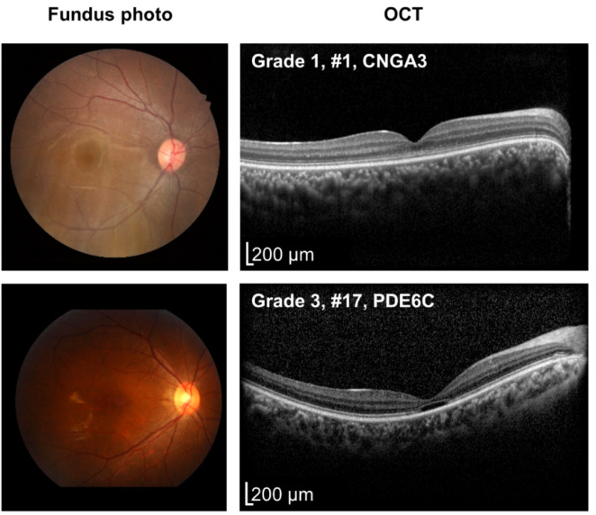 Fundus photographs and OCT of two patients with achromatopsia. The fundus looks almost normal in both. On OCT, the upper patient has a continuous ellipsoid zone, and the lower patient has a dark gap in the ellipsoid zone at the fovea.