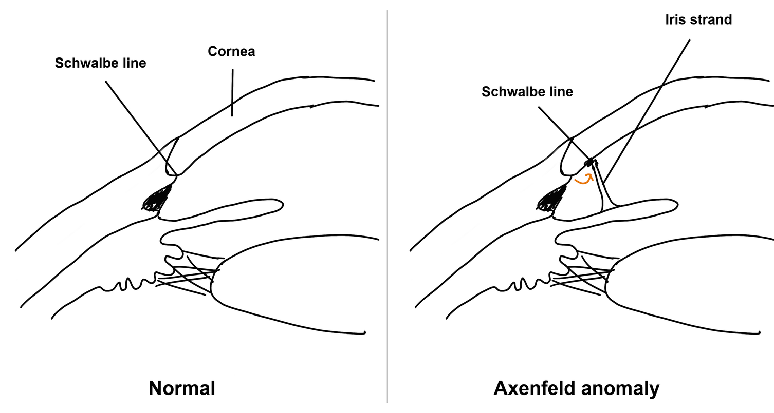 Two hand-drawn cross sections of the anterior chamber angle. Left, normal: the Schwalbe line sits at the end of the cornea. Right, Axenfeld anomaly: the Schwalbe line has moved forward onto the back of the cornea, shown by an orange arrow, and an iris strand runs from the iris to it.