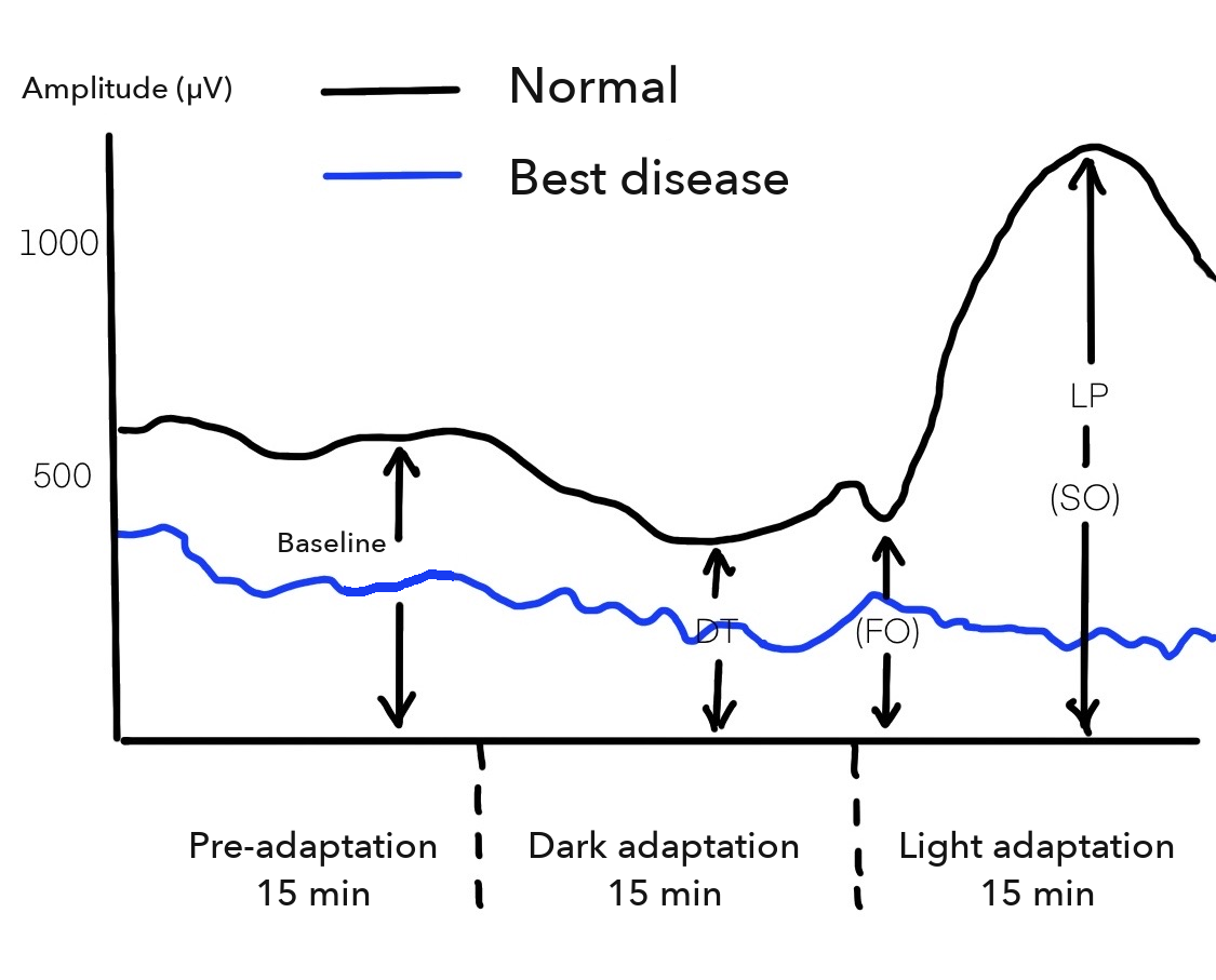 Hand-drawn EOG curves over 45 minutes: the normal curve dips in the dark and rises to a high peak in the light, while the Best disease curve stays low and flat