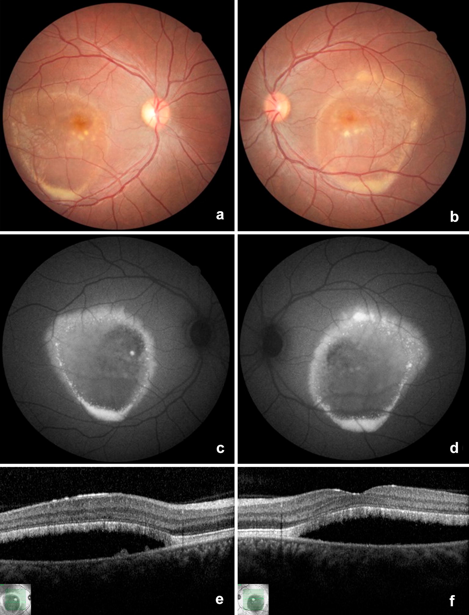 Two color fundus photographs, two autofluorescence images and two OCT scans of both eyes of one patient