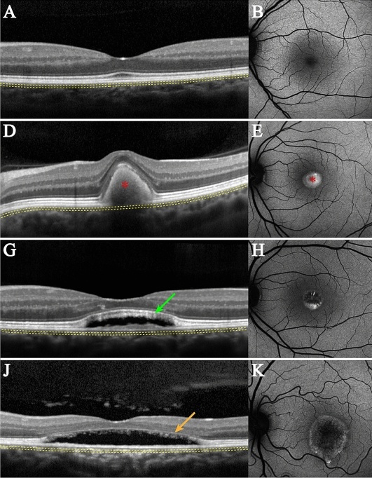 Four rows of OCT scans and autofluorescence images, one row for each of stages 1 to 4