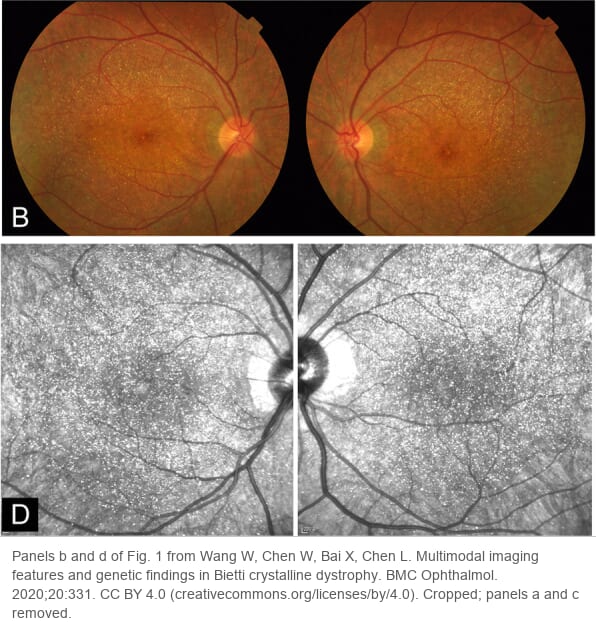 Color fundus photographs of both eyes of a patient with Bietti crystalline dystrophy, above, and near-infrared images of the same eyes, below. Fine bright crystals are scattered over the posterior pole and are far more visible on the infrared images