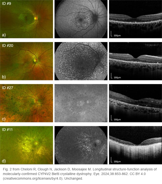Wide-field color photographs, autofluorescence images and OCT scans of four patients with Bietti crystalline dystrophy, aged 17, 29, 31 and 56 from top to bottom. The older patients have wider dark areas on autofluorescence, and in the oldest patient the large choroidal vessels show through the atrophic RPE