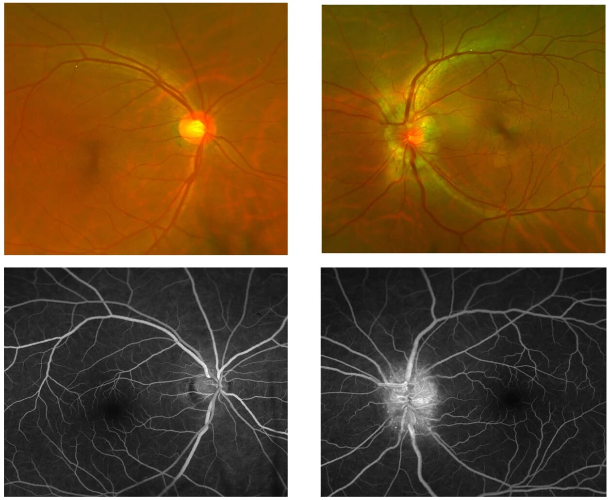 Colour fundus photographs and fluorescein angiography of both eyes in left optic neuritis: the left optic disc is swollen and leaks dye, the right eye is normal