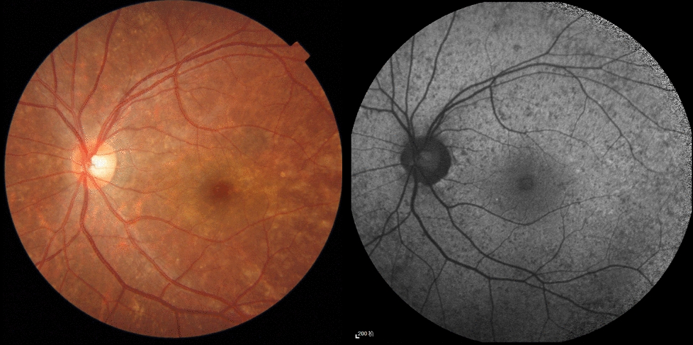 Color fundus photograph and fundus autofluorescence image of a female choroideremia carrier. The fundus shows fine patchy mottling, and autofluorescence shows a granular pattern.