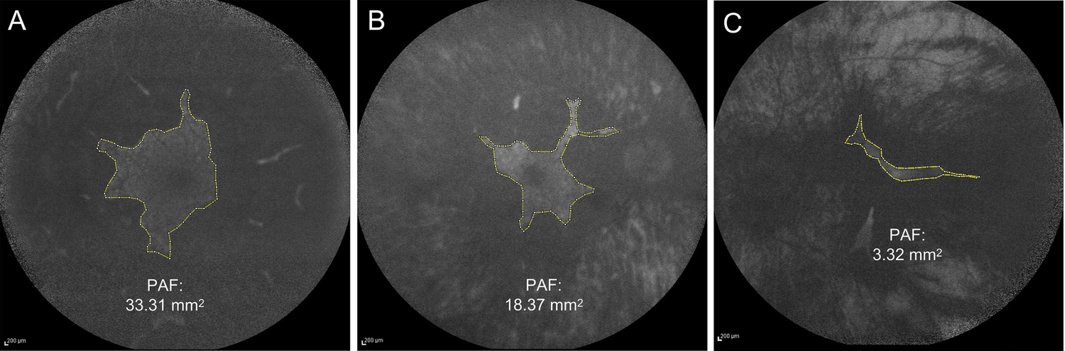 Fundus autofluorescence images of three patients with choroideremia, aged 16, 27 and 52. A yellow dotted line outlines the bright central island of preserved autofluorescence, which is smaller in the older patients.