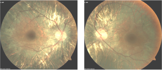 Color fundus photographs of both eyes of a 25-year-old man with choroideremia. The large choroidal vessels show through the atrophic retina, and the macula is preserved.