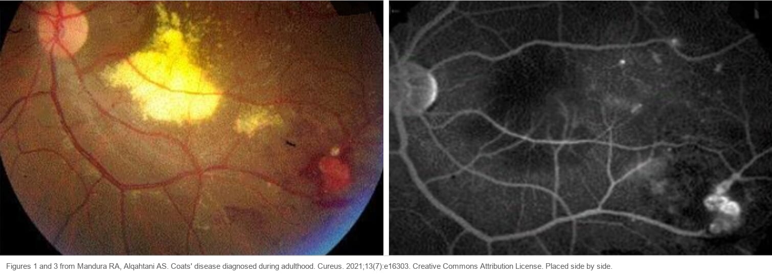 A fundus photograph and a fluorescein angiogram of the same eye. The photograph shows a yellow mass of lipid exudate near the macula and abnormal vessels with hemorrhage in the inferotemporal periphery. The angiogram shows bright leakage from the same peripheral vessels