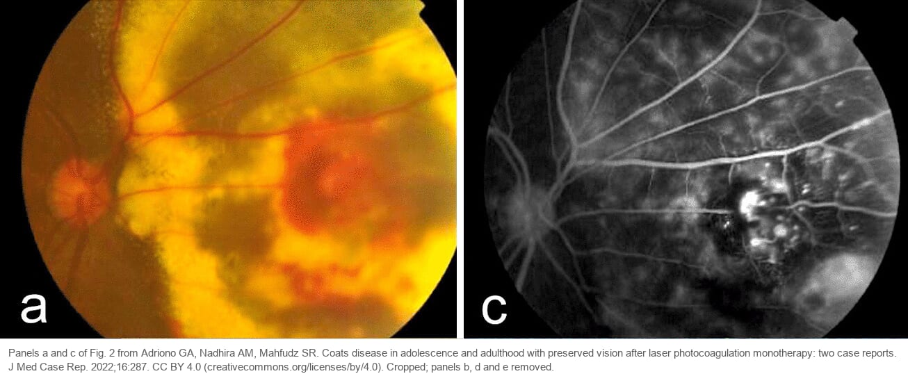 A fundus photograph with wide yellow exudate and hemorrhage, and a fluorescein angiogram with bright leaking telangiectatic vessels surrounded by dark nonperfused retina