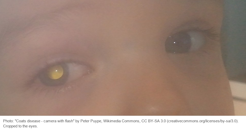 A flash photograph of a young child's eyes. The pupil of the child's right eye glows yellow-white, while the left pupil looks dark