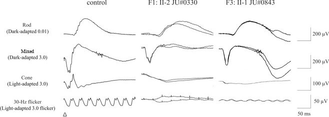 Full-field ERG of a normal eye and two patients with cone-rod dystrophy. In the patients, the rod and mixed responses are recorded, but the cone response and the 30 Hz flicker are nearly flat.
