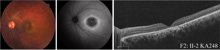 Color fundus photograph, fundus autofluorescence and OCT of a patient with cone-rod dystrophy. The fundus shows atrophy at the macula, autofluorescence shows a dark center surrounded by a bright ring, and OCT shows a thin outer retina at the fovea.