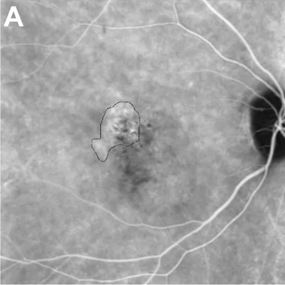 A mid-phase indocyanine green angiogram of a right eye with CSC. A small bright, mottled plaque near the fovea is outlined with a thin line.