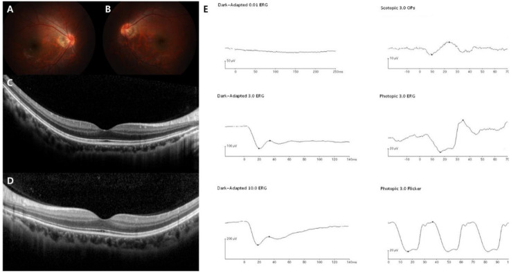 Color fundus photographs, OCT scans and a full set of full-field ERG traces from one patient with complete CSNB