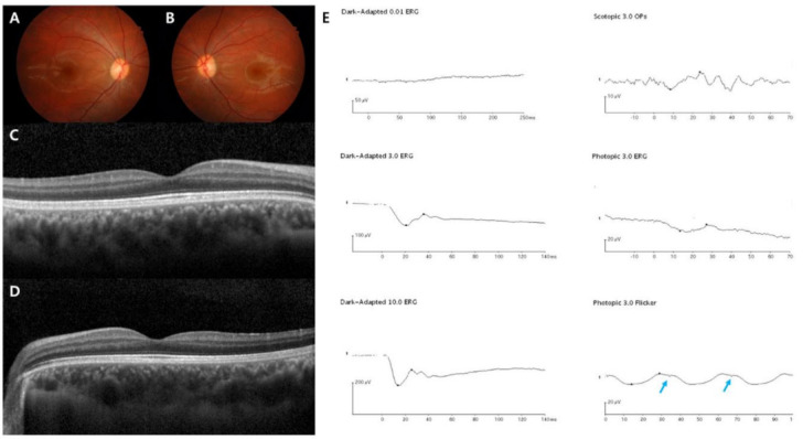 Color fundus photographs, OCT scans and a full set of full-field ERG traces from one patient with incomplete CSNB