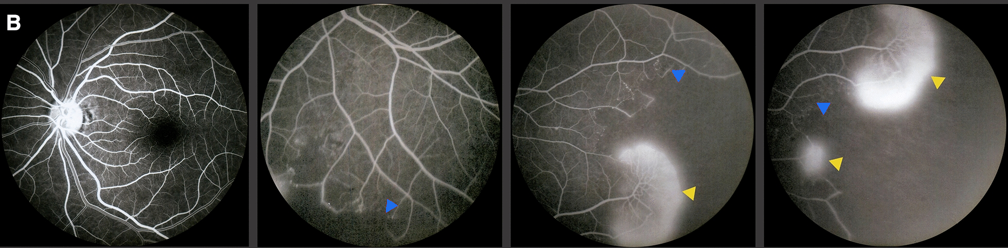 Four fluorescein angiography frames of the left eye, whose fundus looked normal. The posterior pole is normal. In the periphery, blue arrowheads mark dark nonperfused areas and yellow arrowheads mark bright leakage from new vessels.