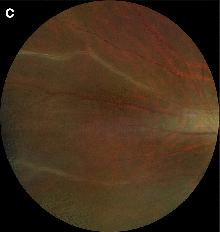 A fundus photograph of the peripheral retina. Several veins have white lines running along their walls.