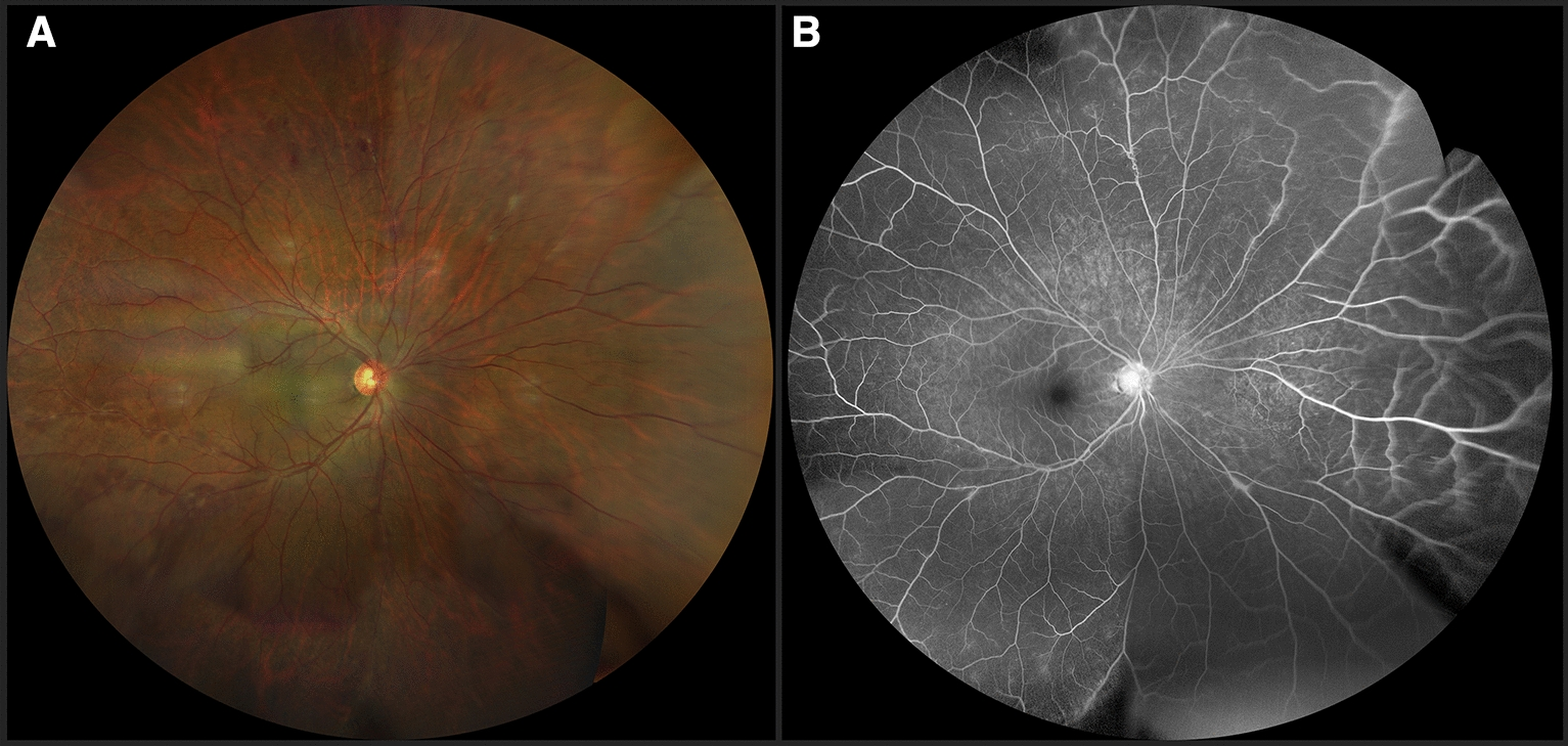 Left: a wide-field fundus photograph with sheathed vessels and hemorrhages in the periphery. Right: wide-field fluorescein angiography of the same eye. The nasal periphery is dark, with no capillaries.