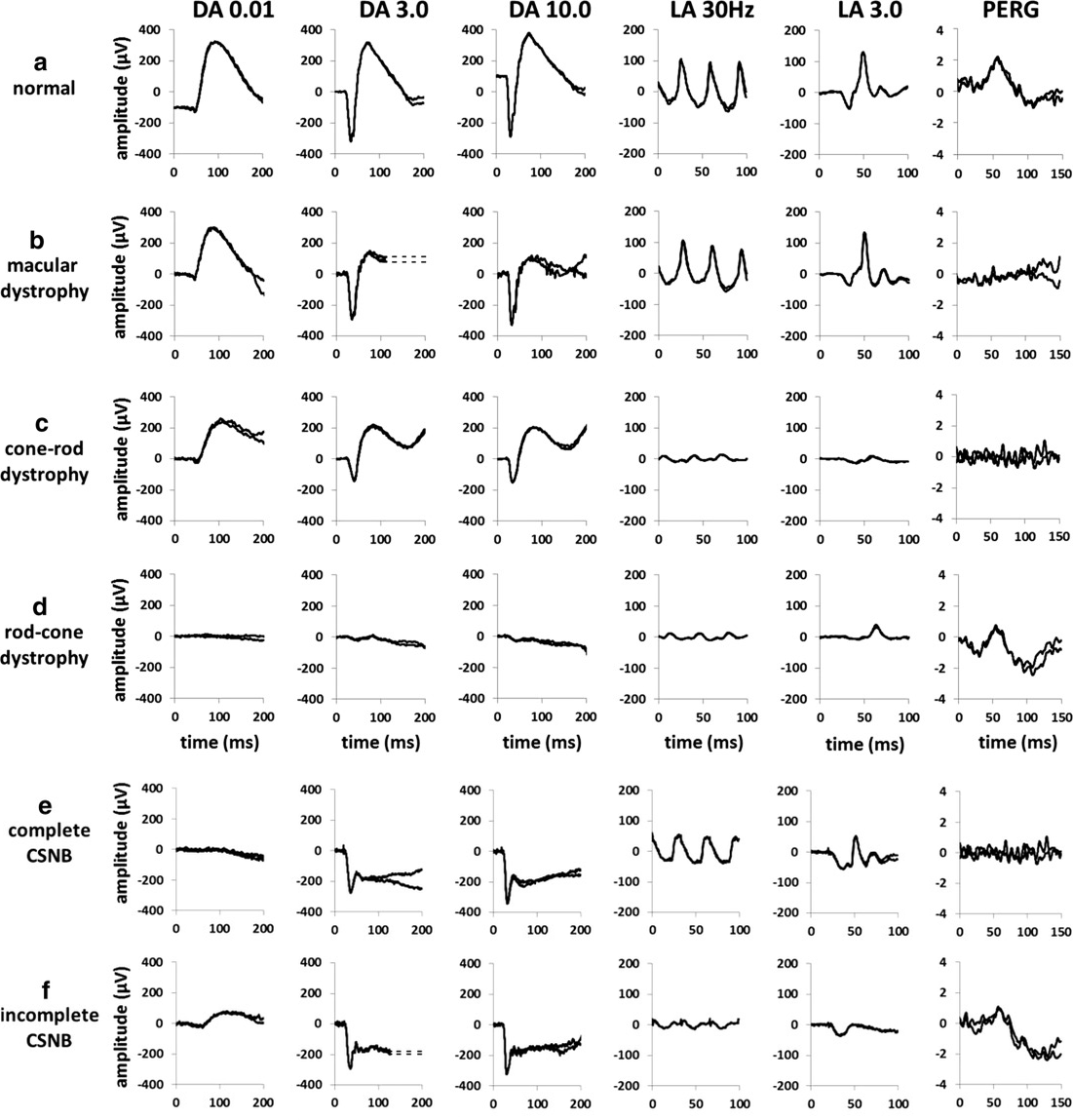 Full-field ERGs and pattern ERGs from six patients, one per row: normal, macular dystrophy, cone-rod dystrophy, rod-cone dystrophy, complete CSNB and incomplete CSNB. Columns show the dark-adapted 0.01, 3.0 and 10.0 responses, the light-adapted 30 Hz flicker and 3.0 responses, and the pattern ERG.