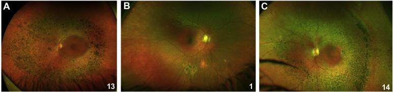 Wide-field color fundus photographs of three patients with enhanced S-cone syndrome showing round pigment clumps in the mid-periphery and along the vascular arcades