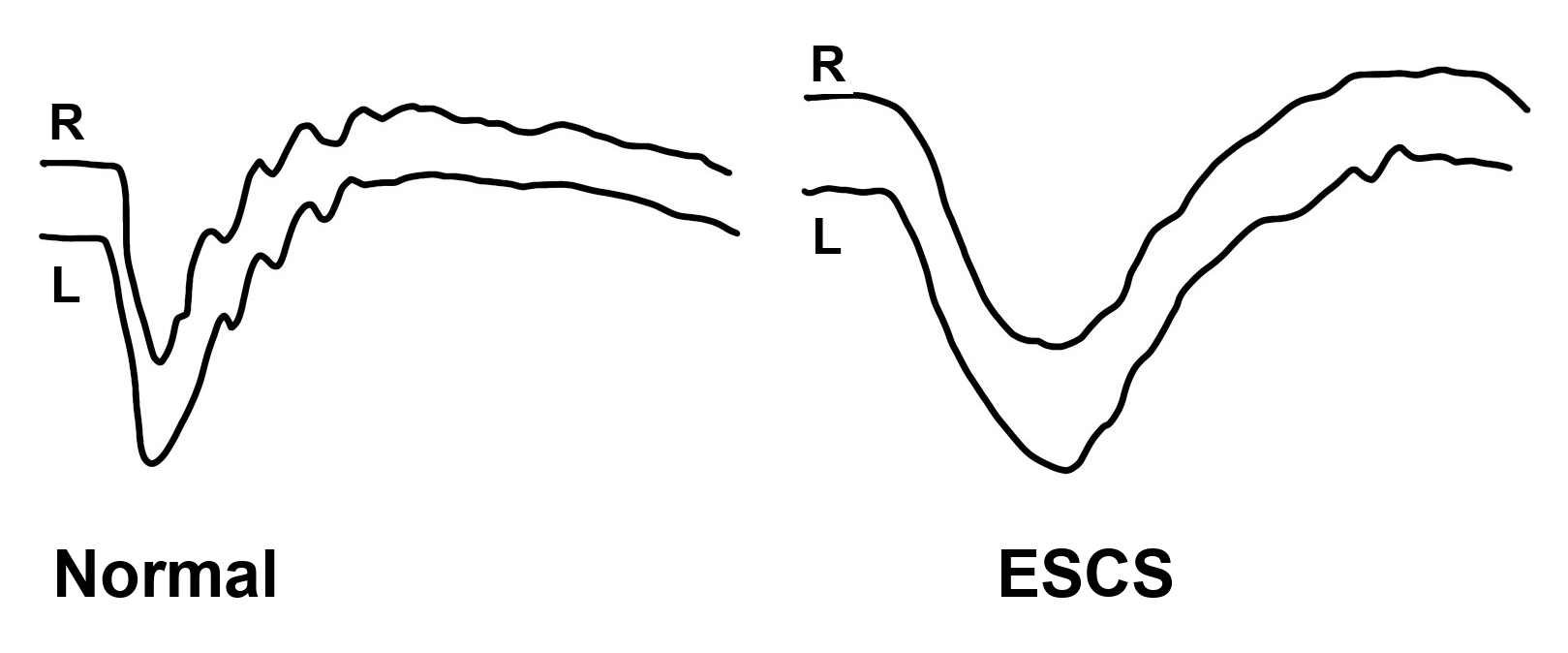 Hand-drawn mixed response ERG of the right and left eyes, normal on the left and enhanced S-cone syndrome on the right. The normal a-wave is sharp and the b-wave rises fast with small wavelets. In ESCS the a-wave falls slowly, the trough is wide and round, and the b-wave climbs back slowly.