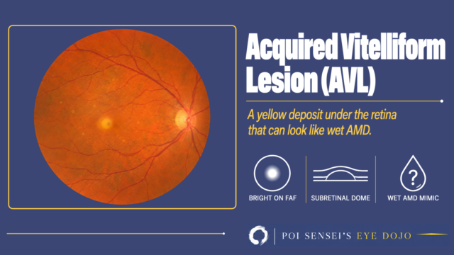 Acquired vitelliform lesion: fundus photograph with a small yellow deposit at the fovea
