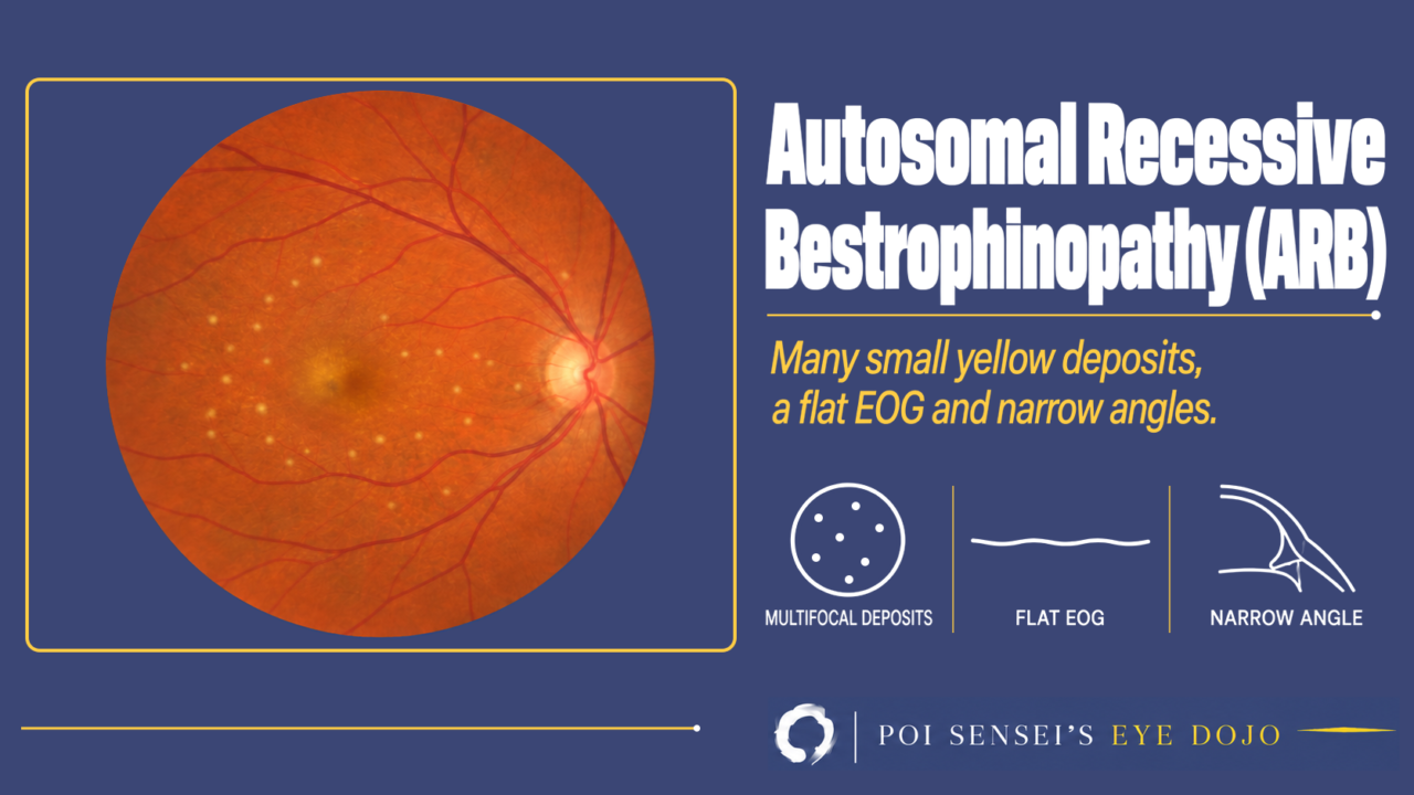 Autosomal recessive bestrophinopathy: fundus photograph with many small yellow deposits over the posterior pole