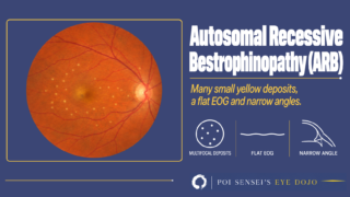 Autosomal recessive bestrophinopathy: fundus photograph with many small yellow deposits over the posterior pole