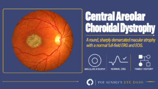 Central Areolar Choroidal Dystrophy: a fundus photograph with a round, sharply demarcated patch of macular atrophy