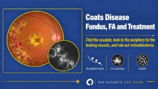 Thumbnail for Coats Disease: Fundus, FA and Treatment, with an illustrated fundus showing macular exudate and peripheral telangiectatic vessels