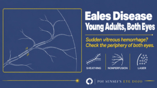 Eales Disease thumbnail: a line drawing of a peripheral retinal vein with white sheathing along its walls, branches ending at a nonperfused border