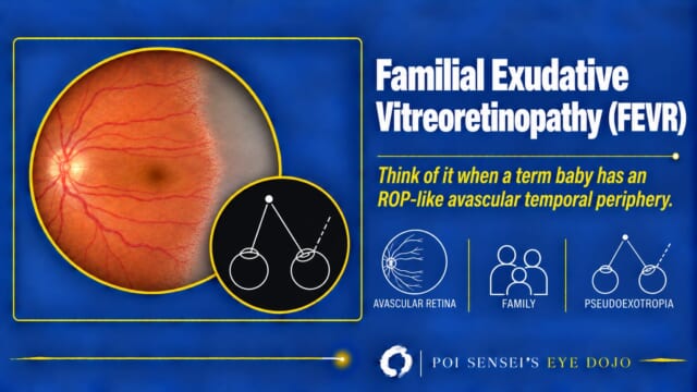 Familial exudative vitreoretinopathy (FEVR): fundus with an avascular temporal periphery and a diagram of pseudoexotropia