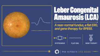 Leber Congenital Amaurosis: a near-normal fundus, a flat ERG and gene therapy