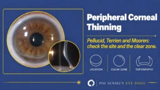 Peripheral Corneal Thinning: an eye with an inferior crescent of corneal thinning and a slit-beam inset