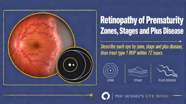 Thumbnail: infant fundus with dilated tortuous vessels and a stage 3 ridge, with a zone diagram, for Retinopathy of Prematurity: Zones, Stages and Plus Disease