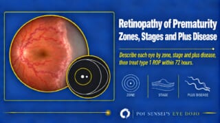 Thumbnail: infant fundus with dilated tortuous vessels and a stage 3 ridge, with a zone diagram, for Retinopathy of Prematurity: Zones, Stages and Plus Disease