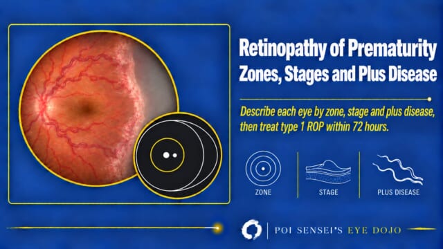 Thumbnail: infant fundus with dilated tortuous vessels and a stage 3 ridge, with a zone diagram, for Retinopathy of Prematurity: Zones, Stages and Plus Disease